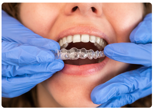 Invisalign-Visit-3--Treatment-Plan-and-Aligners