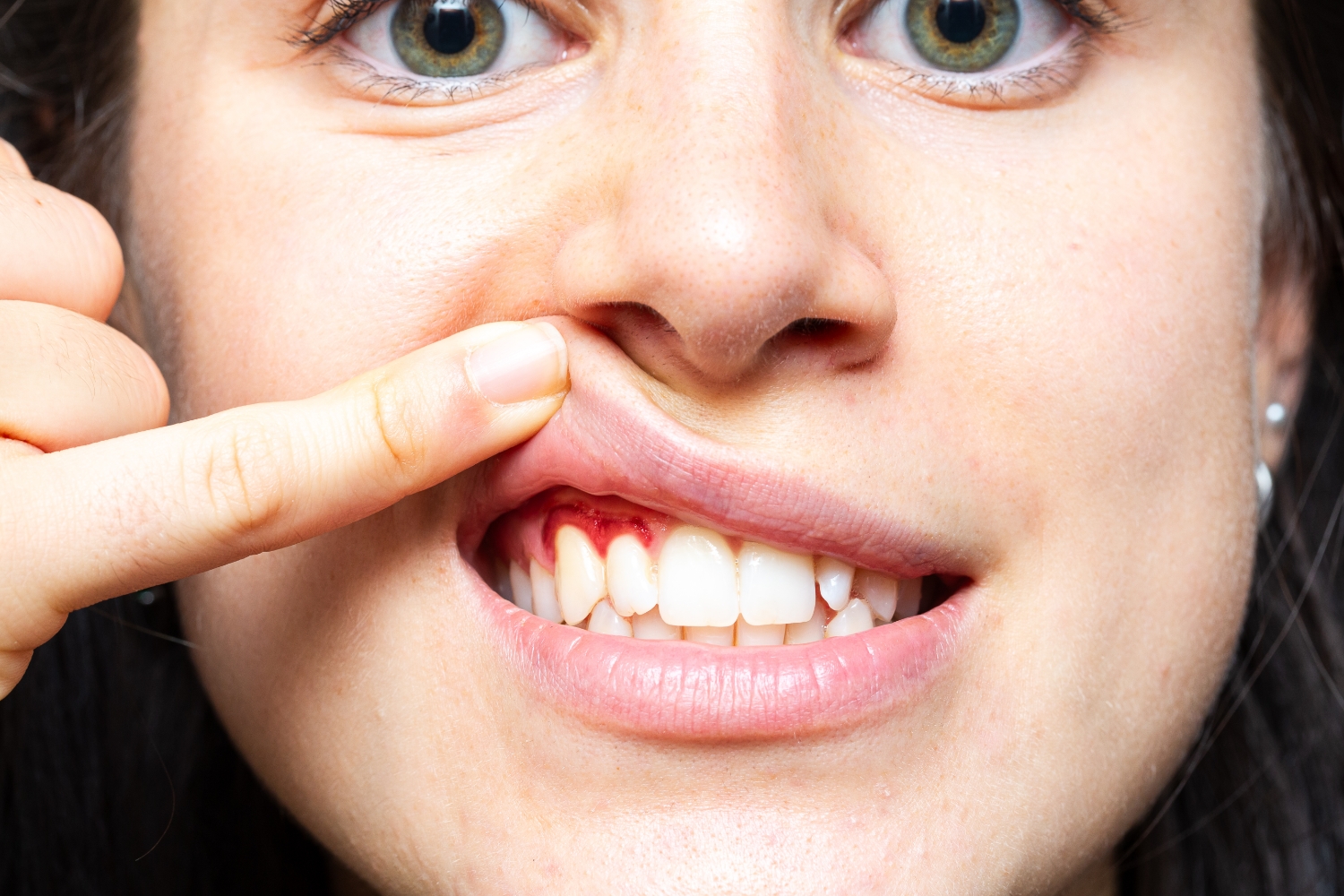 Bleeding Gums When Brushing? Here’s What Your Gums May Be Trying to Tell You
